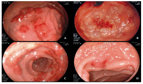 Videoendoscopía digestiva alta: compromiso gástrico y duodenal. A) Lesiones elevadas rojizas en el cuerpo gástrico con una ulceración central y una tendencia a confluir. B) Lesiones rojizas de aproximadamente 15 mm en el fondo gástrico. C y D) Lesiones rojizas elevadas múltiples que tienden a confluir en la primera y en la segunda porción duodenal
