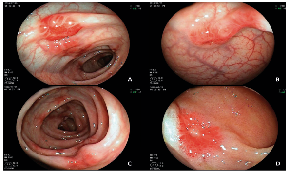 Videocolonoscopía. A, B y C) Compromiso del colon con las lesiones rojizas nodulares umbilicadas. Algunas lesiones rojizas planas en el colon transverso. D) Lesión ileal rojiza de aproximadamente 12 mm con el centro ulcerado