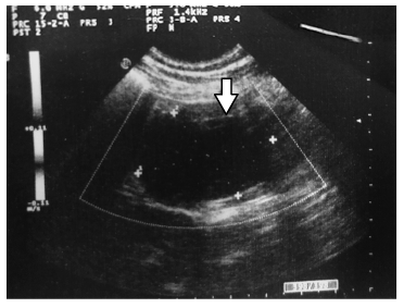 La ecograf&iacute;a abdominal muestra un espacio sin ecos (flecha), correspondiente al hematoma duodenal intramural