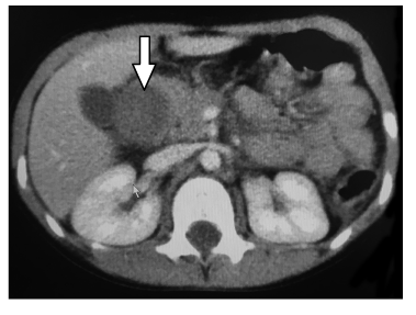 La tomograf&iacute;a computarizada abdominal muestra una masa en la segunda porci&oacute;n del duodeno (flecha), correspondiente al hematoma duodenal intramural