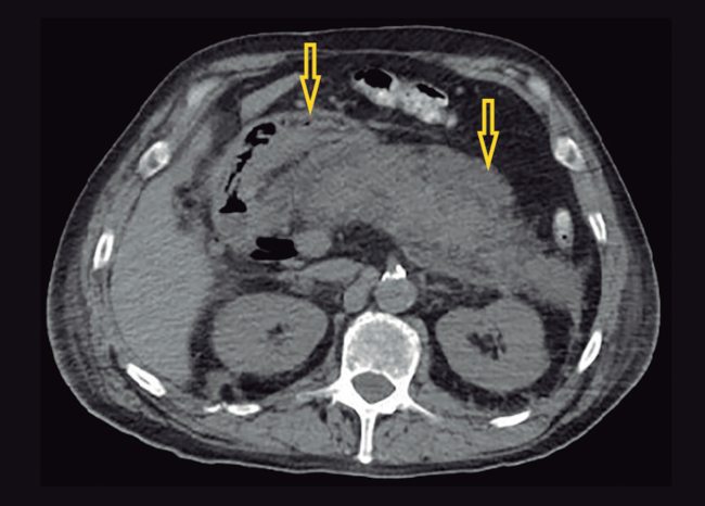 STC de abdomen con colecciones pancreáticas heterogéneas con aire en su interiors