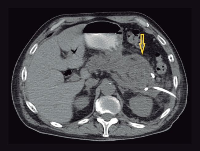 TC axial de abdomen. Se observa persistencia de colección heterogénea en cola de páncreas luego de drenaje percutáneos