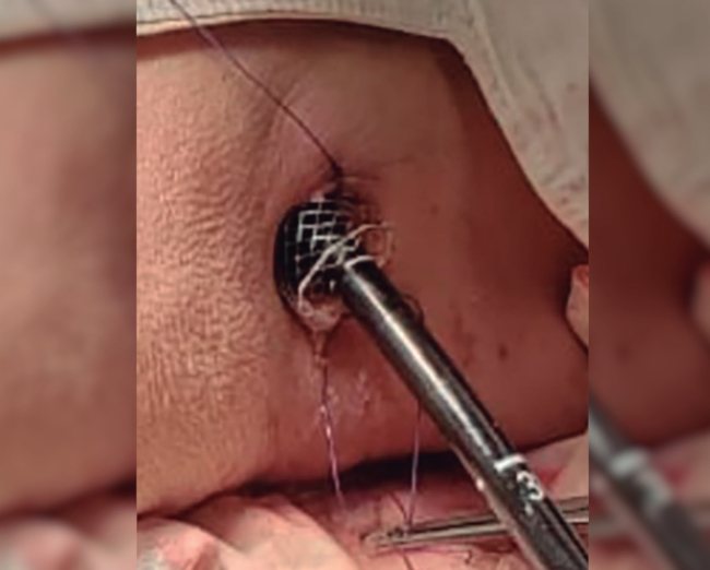 Necrosectomía endoscópica a través de stent metálico esofágico transcutáneo