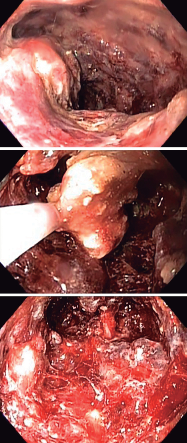 Necrosectomía endoscópica transcutánea. A) Cavidad multicompartimental con tejido necrótico. B) Necrosectomía con asa. C) Paredes de cavidad con tejido de granulación