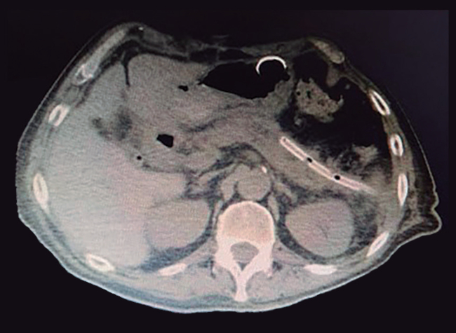 TC corte axial Se observa resolución de colecciones pancreáticas con drenaje percutáneo multipropósito con extremo distal hacia cola de páncreas