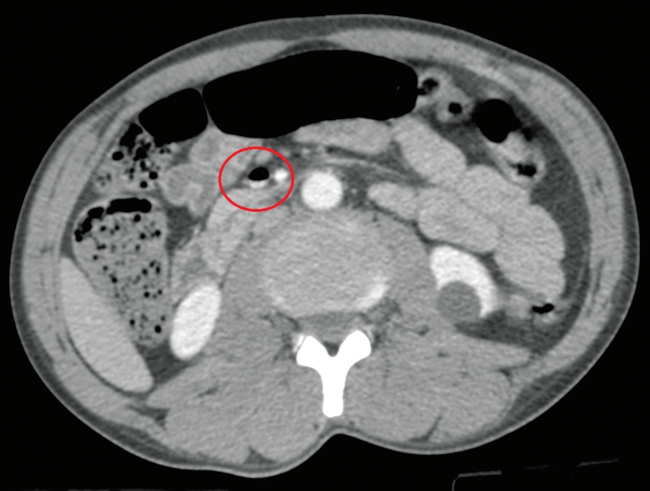 Corte transversal de la tomografía computarizada abdominal en el que se observa gas en la vena mesentérica superior