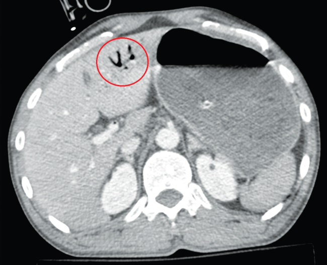 Corte transversal de la tomografía computarizada abdominal en el que se reconoce gas en la vena porta y los radicales portales periféricos