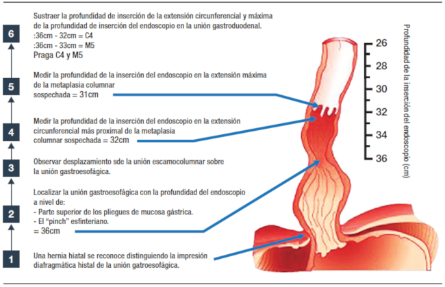 Rol de la endoscopía en la enfermedad por reflujo gastroesofágico