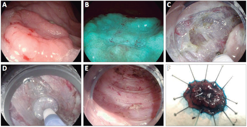 Imgenes endoscpicas de la DSE-TBS del recto