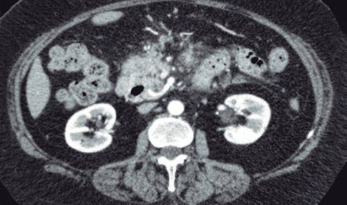 Tomografa Computada con reconstruccin axial de abdomen con contraste endovenoso.