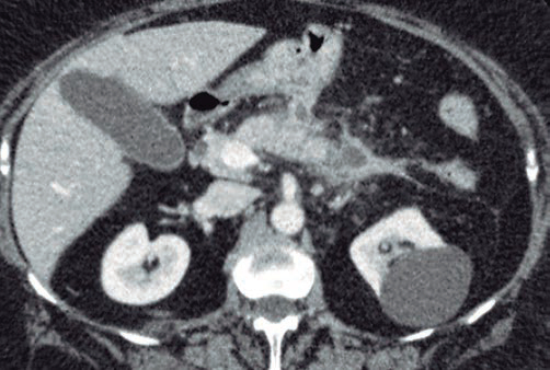 Tomografa Computada con reconstruccin axial de abdomen con contraste endovenoso.