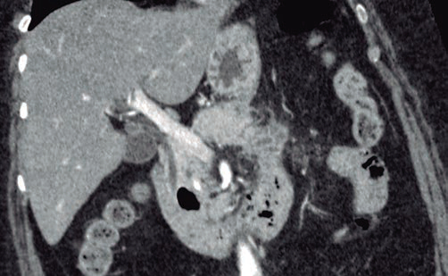 Tomografa Computada con reconstruccin oblicua MPR de abdomen con contraste endovenoso.