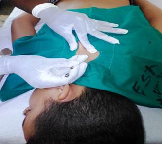 T&eacute;cnica de implantaci&oacute;n de catgut en Ding Chuan