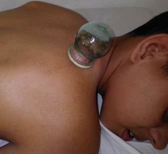 Aplicaci&oacute;n de ventosa fija en vejiga 13