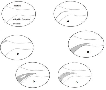 Diferentes modalidades de plica mediopatelar vestigio de plica, B- plica cl&aacute;sica, C- duplicada, D- plica fenestrada y E- plica alta