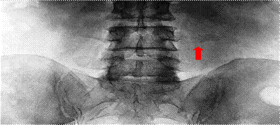 Radiograf&iacute;a simple antero posterior de columna lumbosacra. Se aprecia de manera no muy clara la fractura del proceso espinoso izquierdo de la cuarta v&eacute;rtebra lumbar (flecha roja). Fuente: archivo de im&aacute;genes del Servicio de Imaginolog&iacute;a del Hospital Universitario Manuel Ascunce Domenech