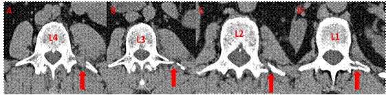 Tomograf&iacute;a axial computarizada simple de columna lumbo-sacra cortes axiales. Fractura de los procesos transversos izquierdos de A: cuarta v&eacute;rtebra lumbar (L4), B: tercera v&eacute;rtebra lumbar (L3), C: segunda v&eacute;rtebra lumbar (L2) y D: primera v&eacute;rtebra lumbar (L1) (flechas rojas). Fuente: archivo de im&aacute;genes del Servicio de Imaginolog&iacute;a del Hospital Universitario Manuel Ascunce Domenech