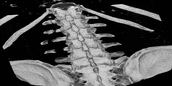 Reconstrucci&oacute;n en tercera dimensi&oacute;n vista posterior que brinda una visi&oacute;n amplia de los procesos transversos fracturados. Fuente: archivo de im&aacute;genes del Servicio de imaginolog&iacute;a del Hospital Universitario Manuel Ascunce Domenech