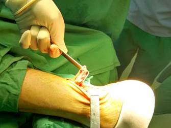 Secci&oacute;n completa del tend&oacute;n de Aquiles en su sitio de inserci&oacute;n