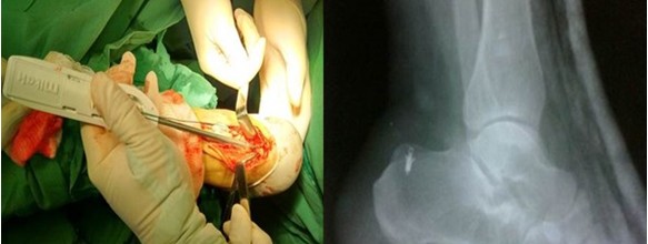 Colocaci&oacute;n del ancla artrosc&oacute;pica en el calc&aacute;neo