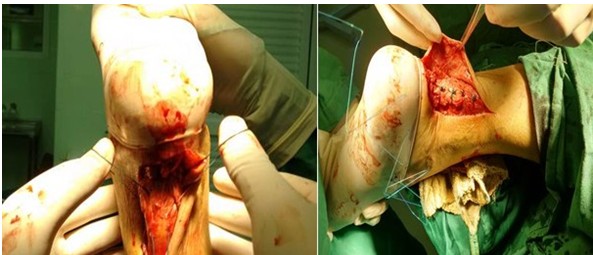 Paso de las suturas a trav&eacute;s del tend&oacute;n (izquierda) y sutura del tend&oacute;n y su vaina previo cierre de la piel (derecha).