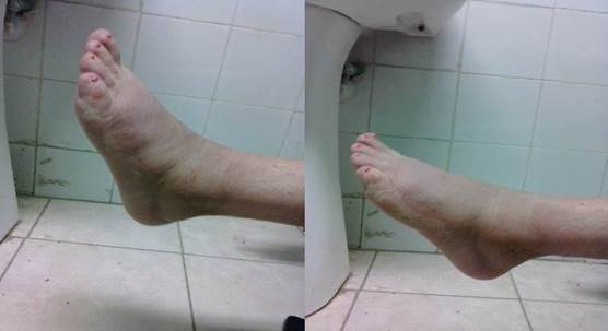 A las seis semanas. Izquierda: extensi&oacute;n del tobillo, a la derecha flexi&oacute;n del tobillo