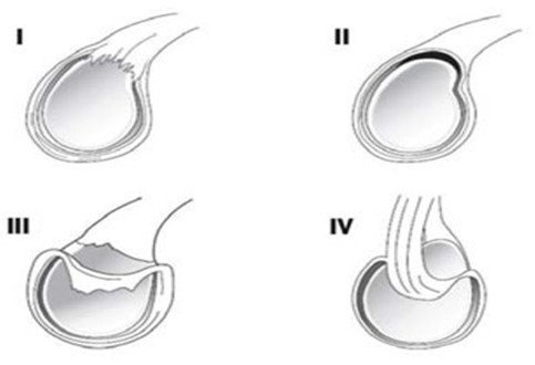 Clasificaci&oacute;n de las primeras cuatro lesiones descritas del labrum superior de la glenoides.