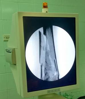 Alineaci&oacute;n de fractura conminuta del extremo distal del f&eacute;mur (imagen propia del autor).