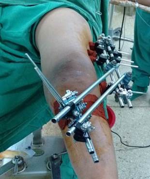 Fijador externo tipo Hoffmann R &reg; colocado para fractura extrarticular distal del f&eacute;mur izquierdo (imagen propia del autor).