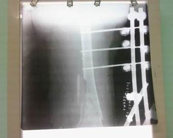 Radiograf&iacute;a anteroposterior que muestra la reducci&oacute;n de la fractura (imagen propia del autor).
