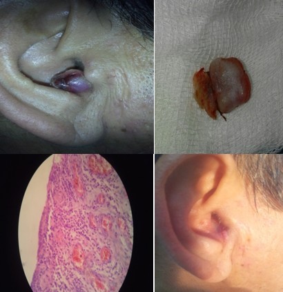 Tumoraci&oacute;n exof&iacute;tica de color rojo viol&aacute;ceo en pared interna del trago, dilataciones vasculares y paciente despu&eacute;s del tratamiento quir&uacute;rgico (im&aacute;genes de los autores).