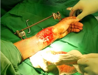 Fijaci&oacute;n externa en pacientes con fractura Abierta grado III B (imagen propia del autor)