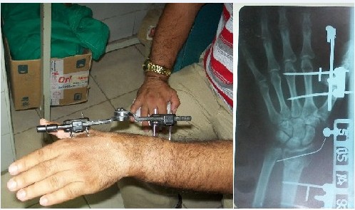 Fijaci&oacute;n externa en pacientes con fractura cerrada del extremo distal del radio (imagen propia del autor)
