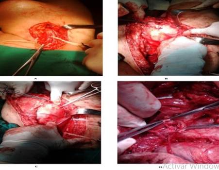 Im&aacute;genes transoperatorias. A- control de la arteria femoral,B y C- identificaci&oacute;n el tumor, D- ligadura de las arterias que irrigan el tumor.