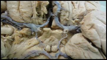 Variante de trayecto de la ACA izquierda