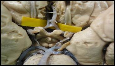 ACoA doble y anastomosada