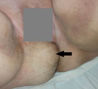 Hernia visible en regi&oacute;n perineal posterior derecha
