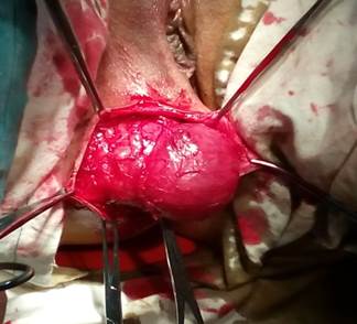 Saco herniario disecado