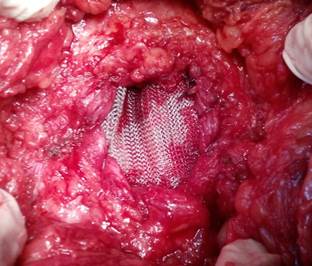 Tap&oacute;n de malla de polipropileno para cubrir el defecto mioaponeur&oacute;tico