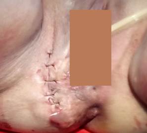 Cierre de la piel con sutura absorbible