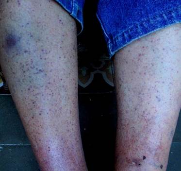 Lesiones purpúricas en ambos miembros inferiores