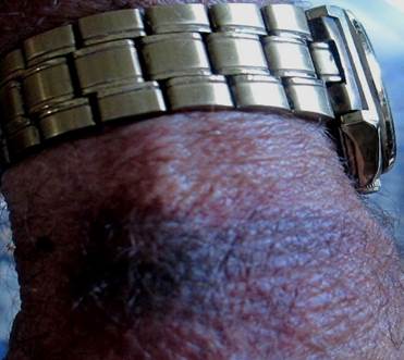 Hematoma en la zona que contacta con el reloj de pulsera