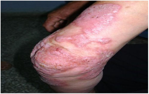 Placa eritematoescamosa, con costras aisladas de bordes bien definidos, arciformes imbricada con zonas hipocr&oacute;micas, en regi&oacute;n medial posterior de brazo y antebrazo izquierdo
