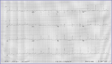 Valor del intervalo PR: 0,89 segundos (muy corto) Valor de QTc medido: Entre 0.356 y 0.334 segundos (muy corto)