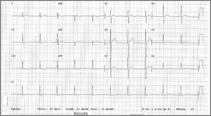 El trazado completo del electrocardiograma basal