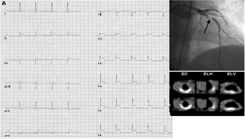 Un Patrón de Breijo junto con un Patrón de Wellens se puede valorar en la imagen 10,11
