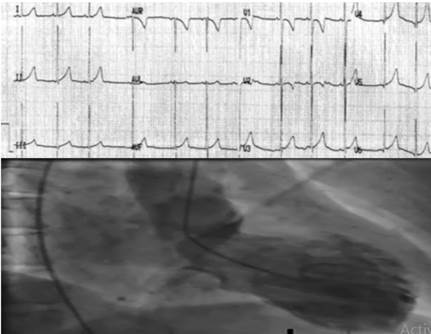 Síndrome del corazón roto" (Takotsubo) y el Patrón de Breijo