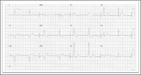 Un WPW junto con un Patrón de Breijose 14