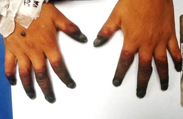 Necrosis acral de dedos de las manos