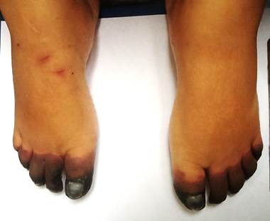 Necrosis acral de dedos de los pies